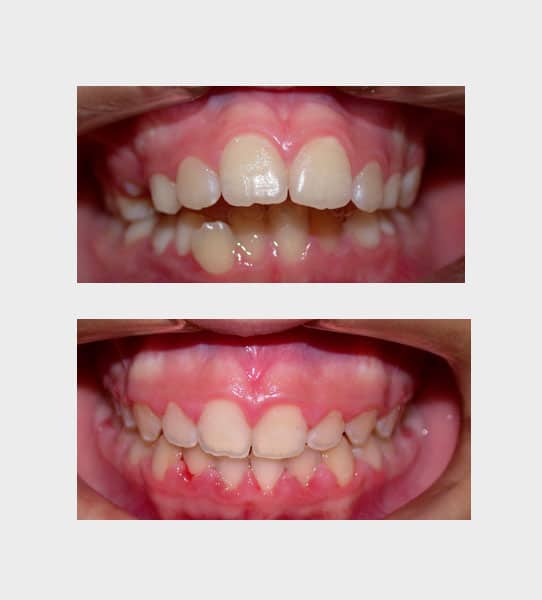 caso-ortodoncia-fija-01