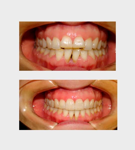 caso-ortodoncia-fija-02