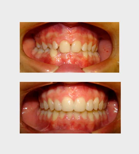 caso-ortodoncia-fija-03