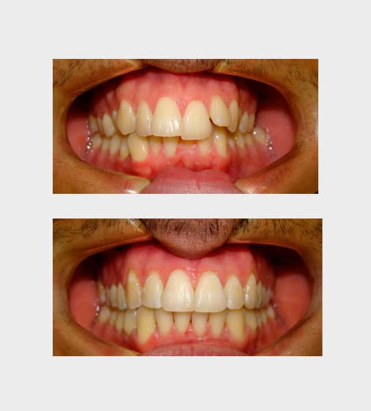 caso-ortodoncia-fija-04