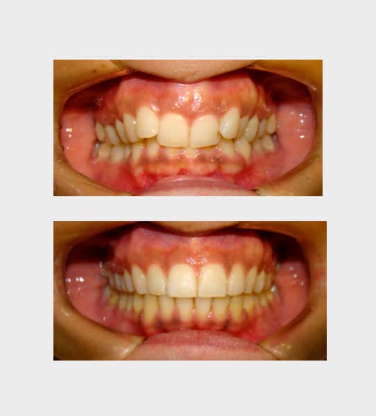 caso-ortodoncia-fija-05