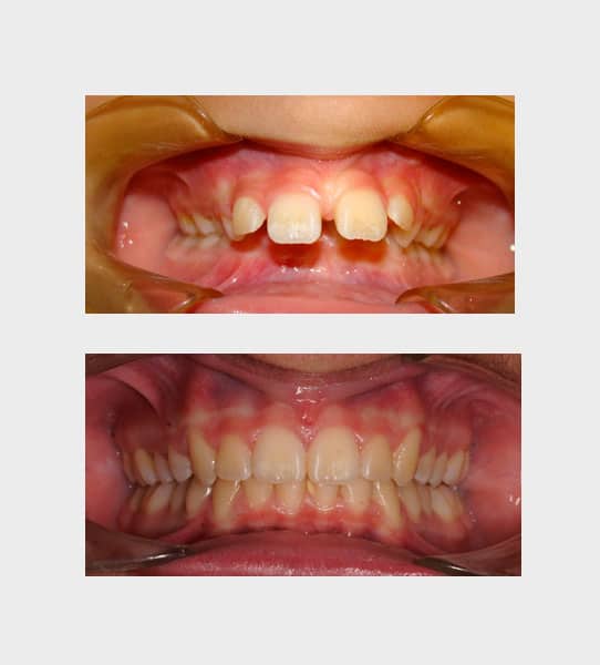 caso-ortodoncia-funcional-01