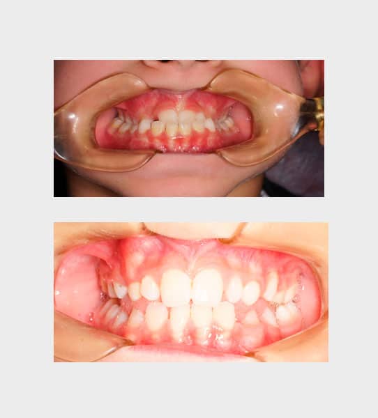 caso-ortodoncia-funcional-01
