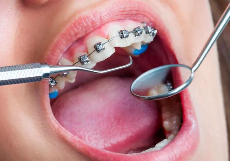 fixed-orthodontics-02
