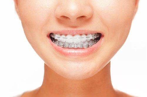 orthodontics-fixed-treatments-san-sebastian