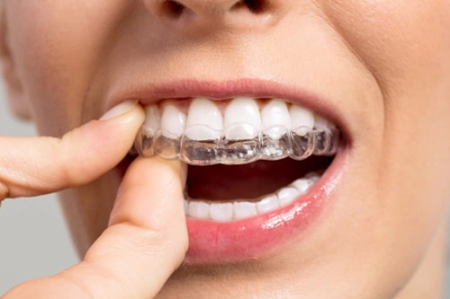 ortodontzia-ikusezina-tratamenduak-donostian